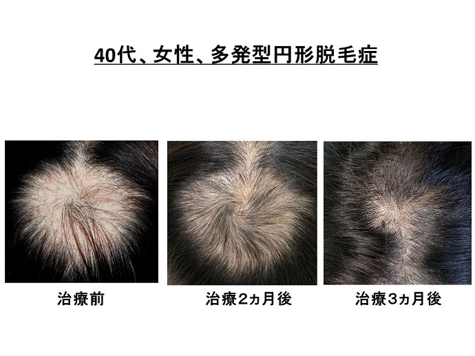 円形脱毛症　病院